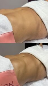 drenagem-linfatica-beneficios